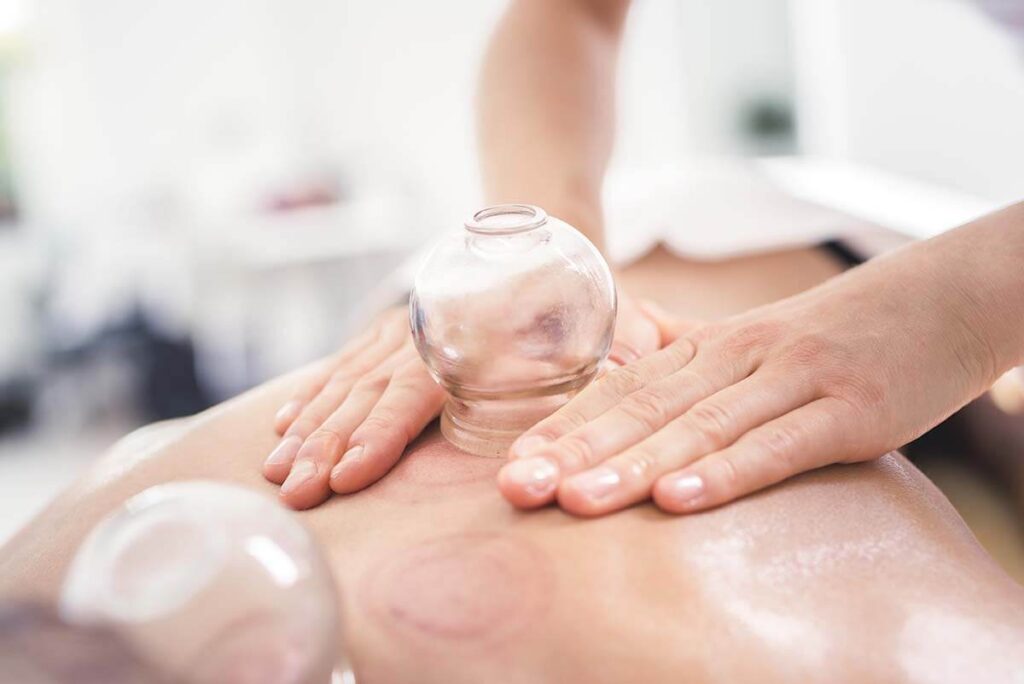 Read more about the article How Cupping Helps With Fertility