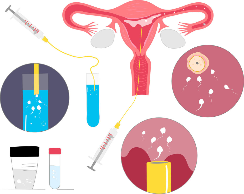 illustration of intrauterine insemination for single-family planning